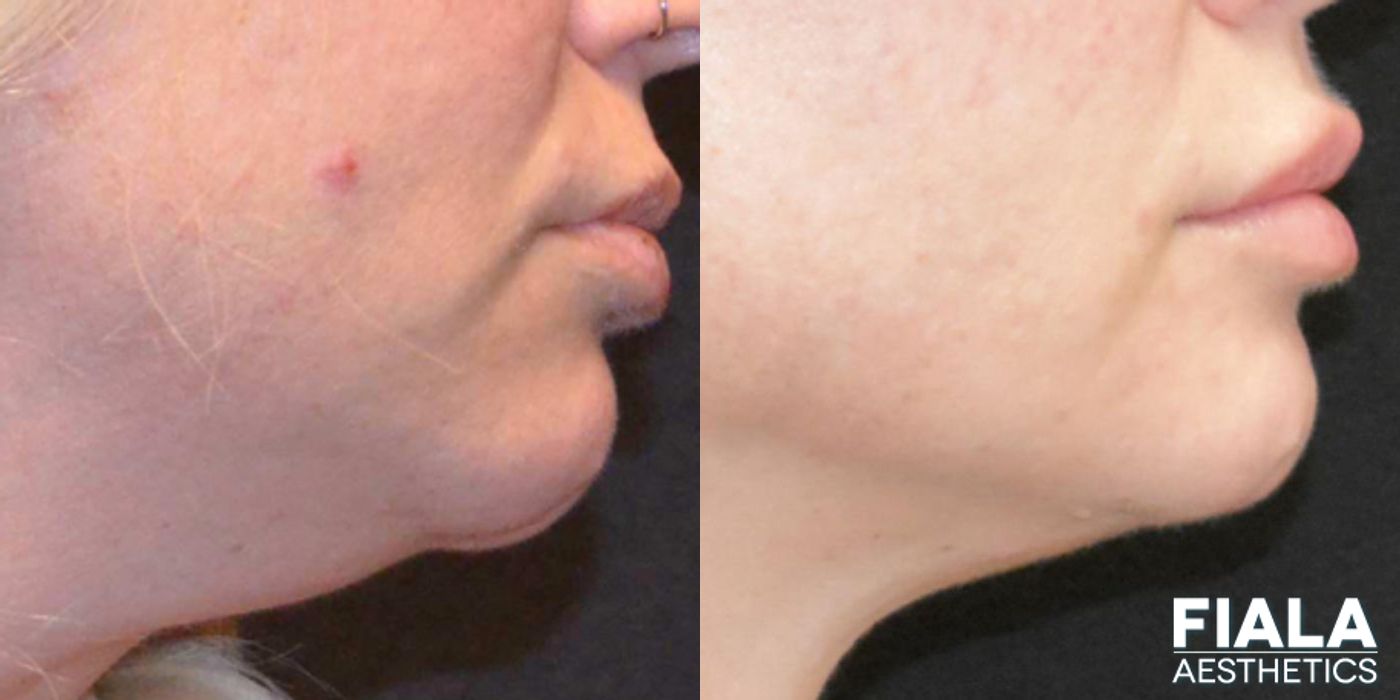 Before and after Dermal Fillers case 13942 - Angle 2