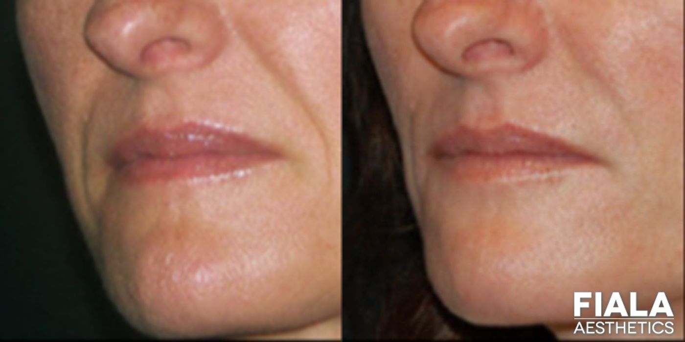 Before and after Dermal Fillers case 13931 - Angle 2