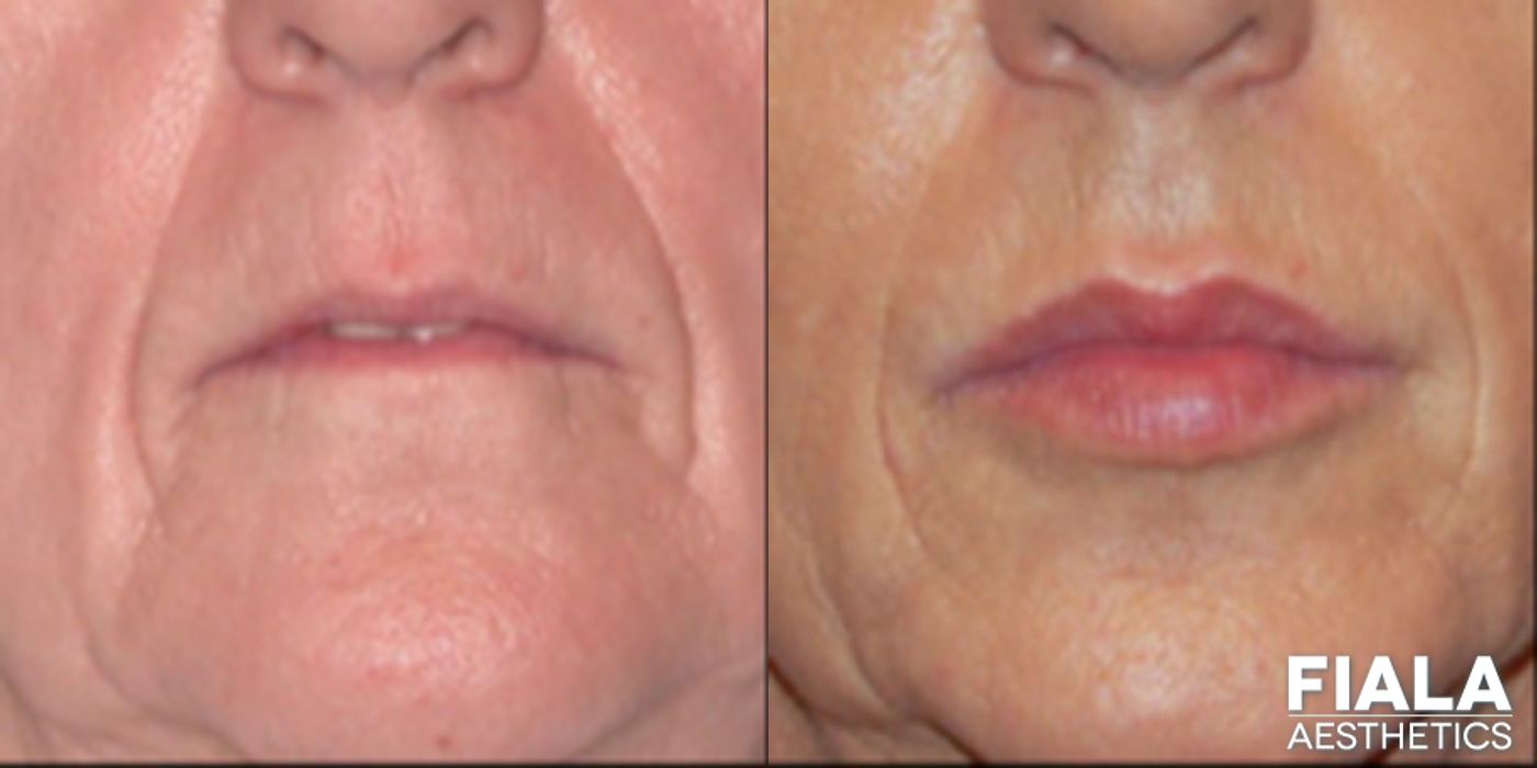Before and after Dermal Fillers case 13930