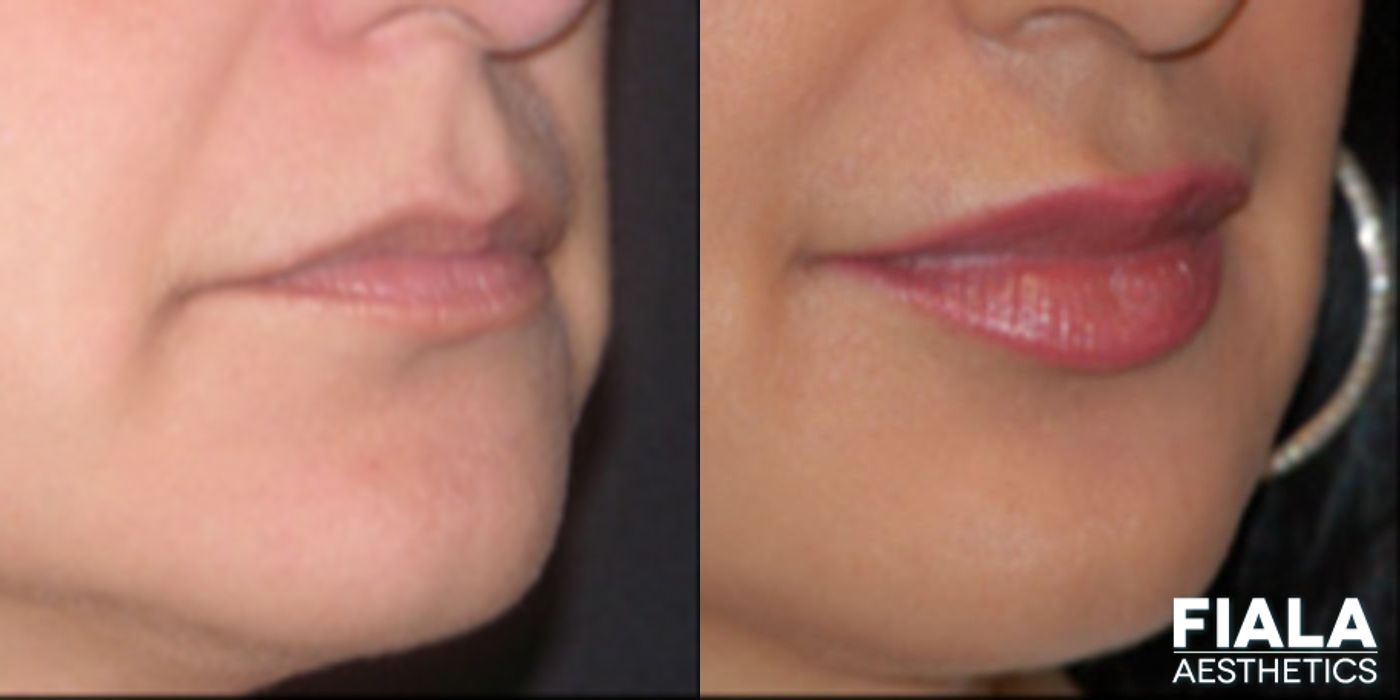 Before and after Dermal Fillers case 13925 - Angle 2