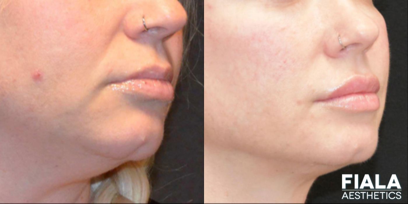 Before and after Dermal Fillers case 13942 - Angle 3