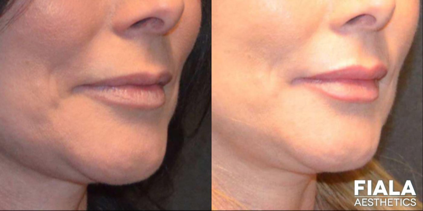 Before and after Dermal Fillers case 13940 - Angle 2