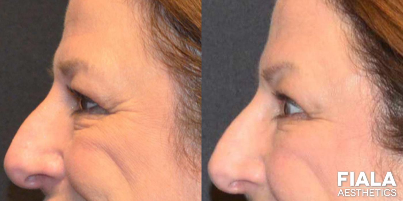 Before and after Dermal Fillers case 13933 - Angle 6