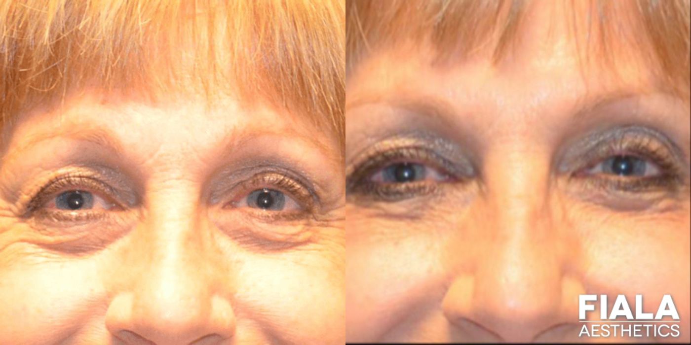 Before and after Dermal Fillers case 13932