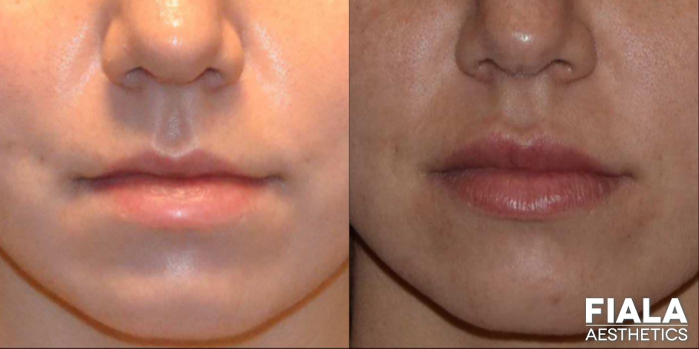 Before and after Dermal Fillers case 13937