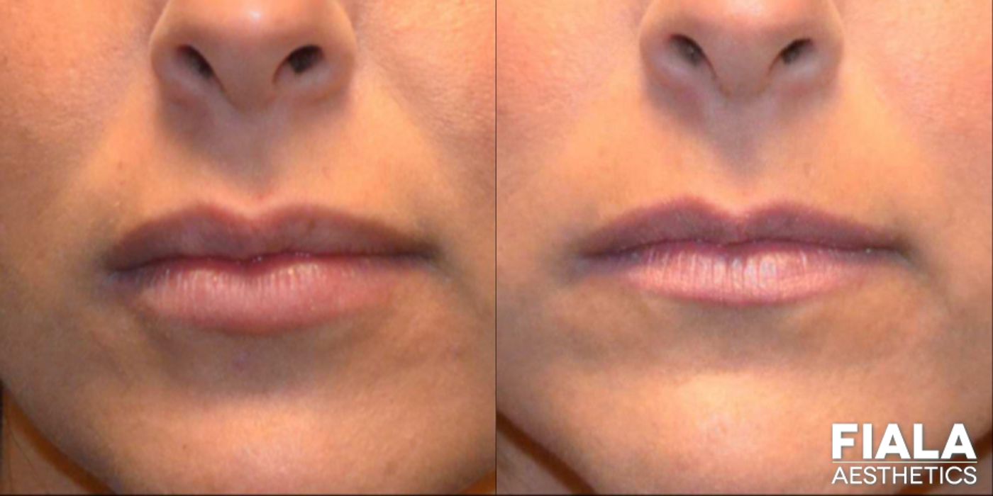 Before and after Dermal Fillers case 13938