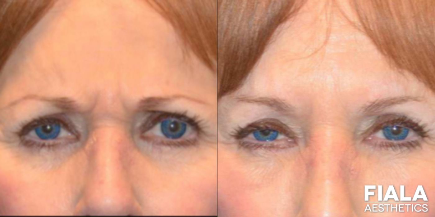 Before and after Dermal Fillers case 13935 - Angle 2