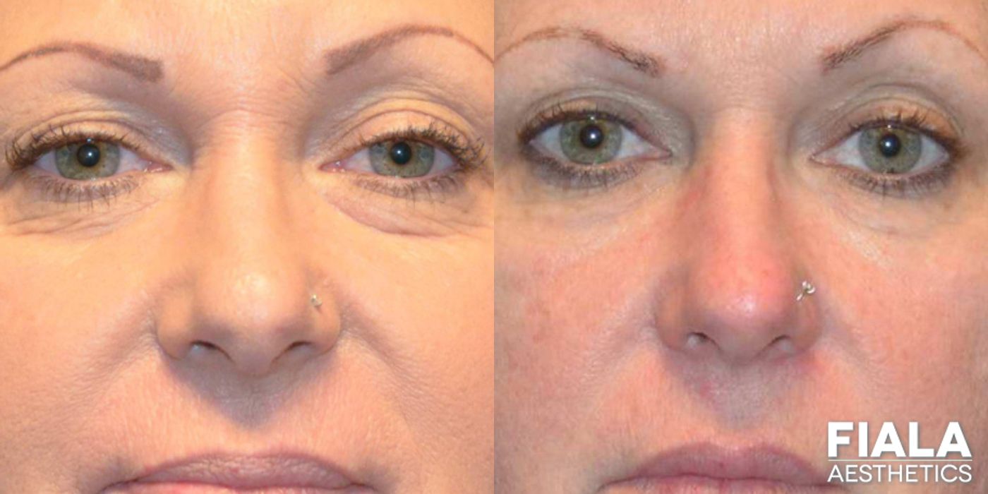Before and after Dermal Fillers case 13936