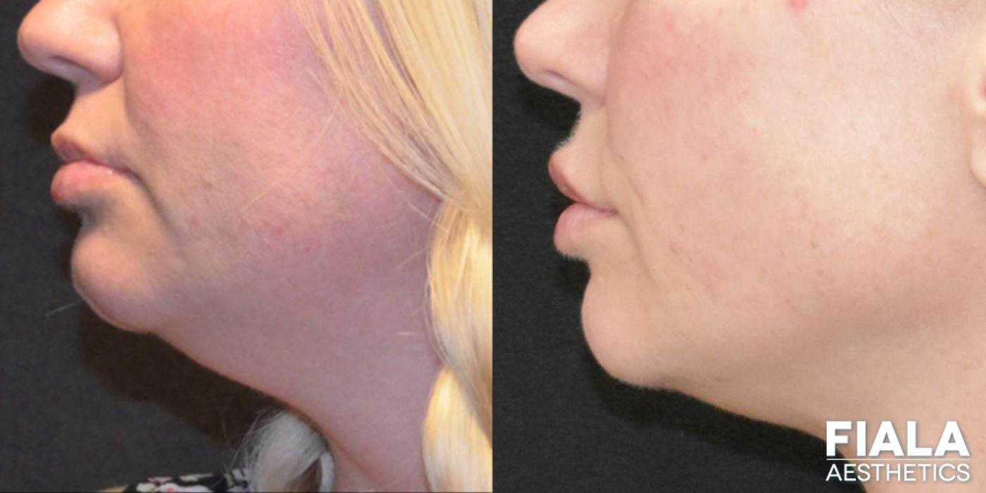 Before and after Dermal Fillers case 13942 - Angle 5