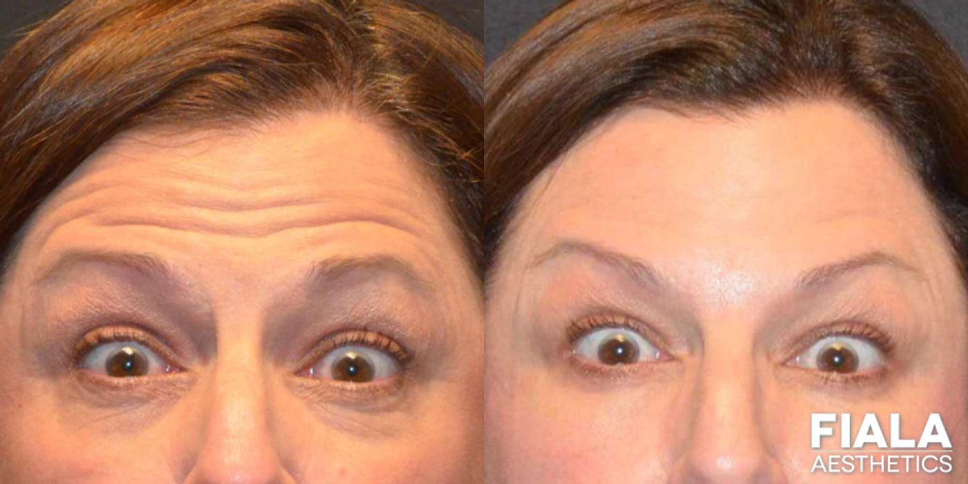 Before and after Dermal Fillers case 13933 - Angle 2