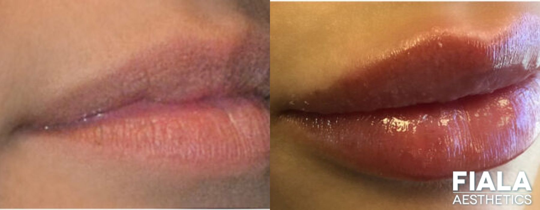 Before and after Dermal Fillers case 13920