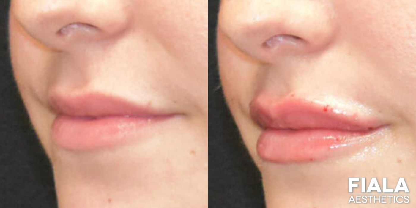 Before and after Dermal Fillers case 13921 - Angle 2