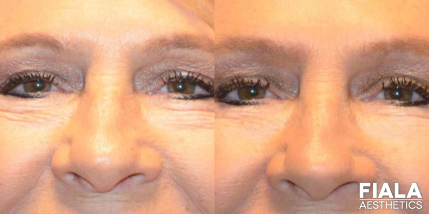 Before and after Dermal Fillers case 13939 - Angle 2