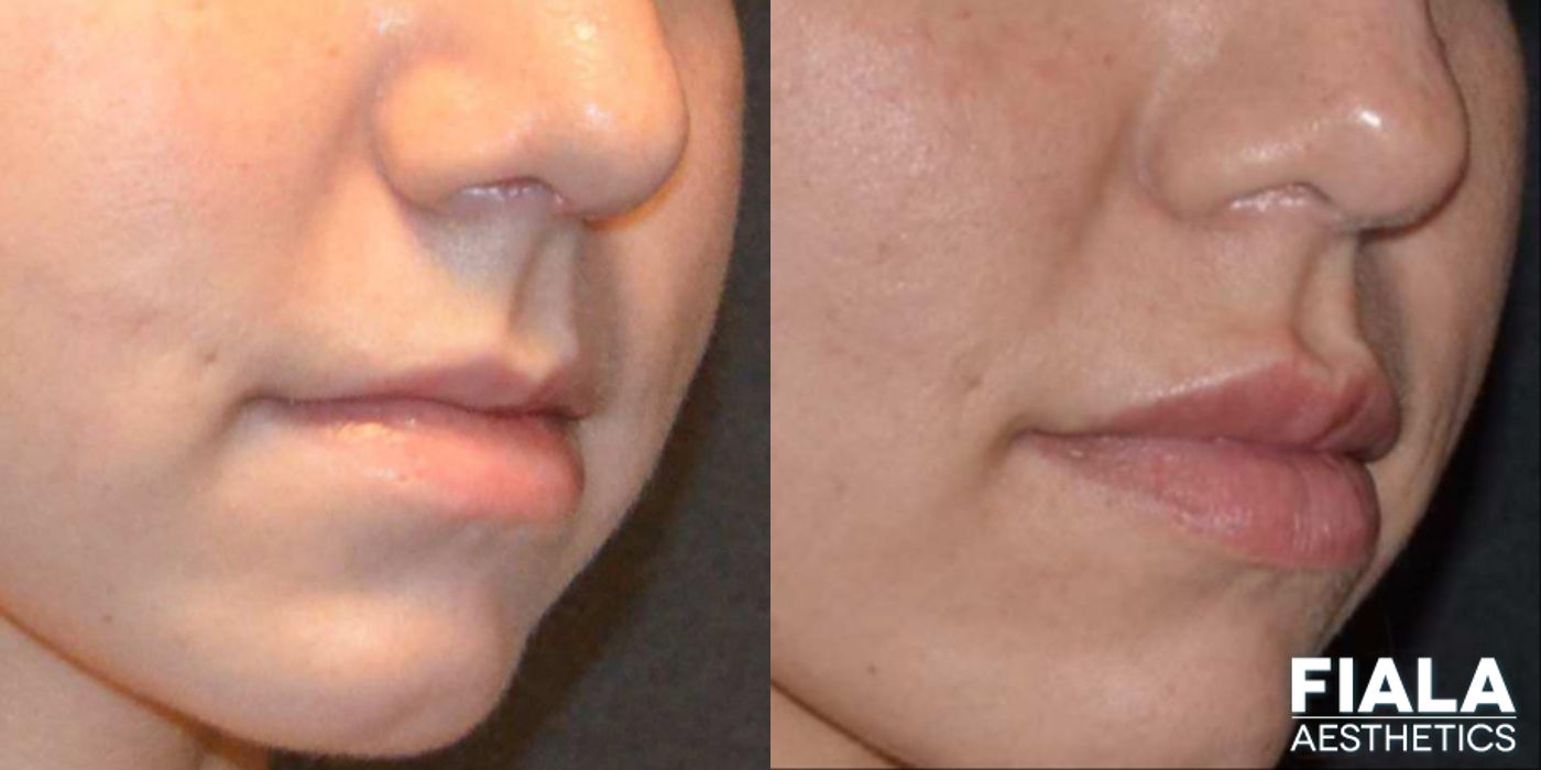 Before and after Dermal Fillers case 13937 - Angle 2