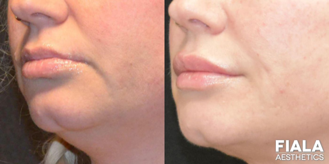 Before and after Dermal Fillers case 13942 - Angle 4