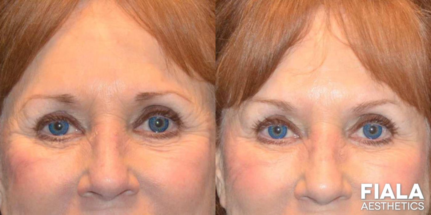 Before and after Dermal Fillers case 13935