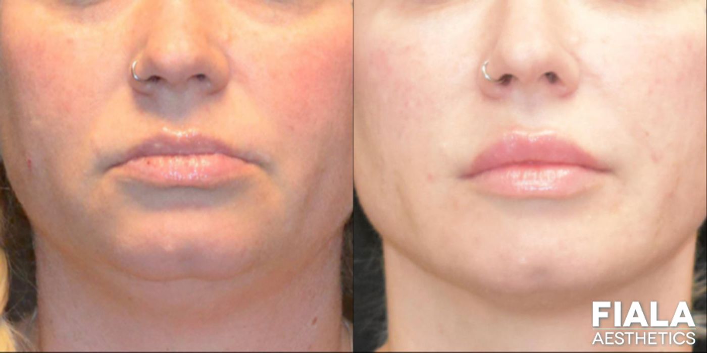 Before and after Dermal Fillers case 13942