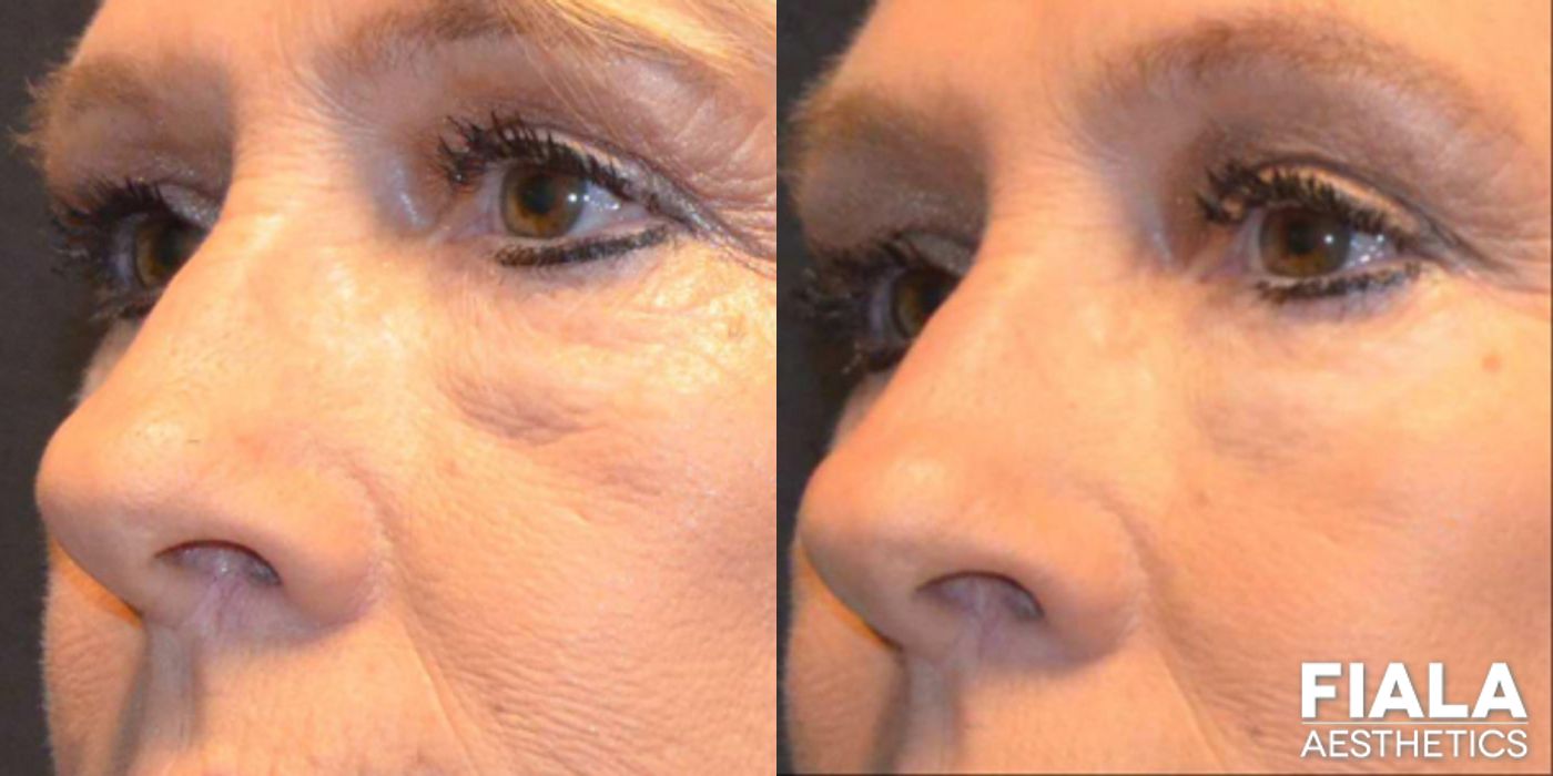 Before and after Dermal Fillers case 13939 - Angle 5