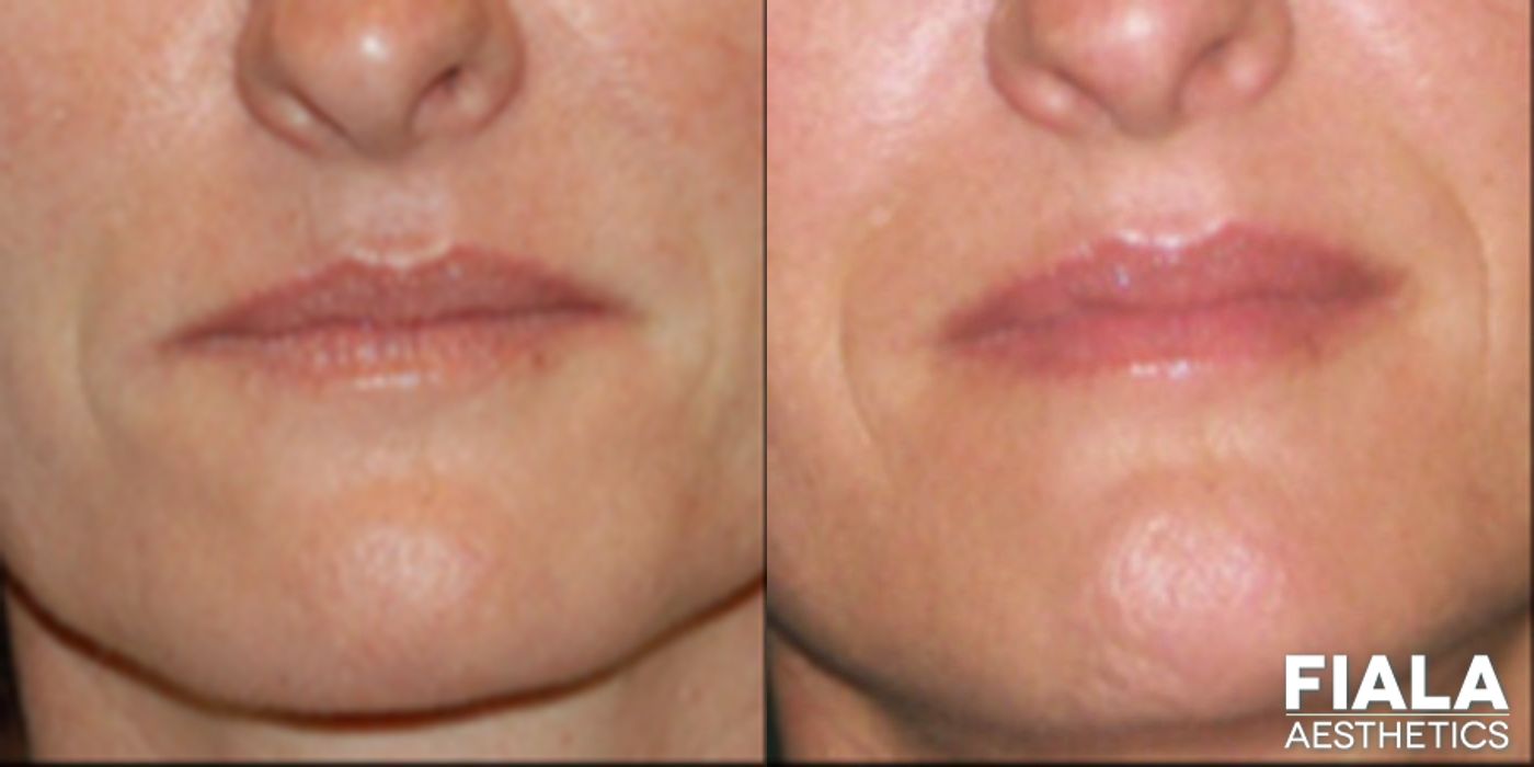 Before and after Dermal Fillers case 13931