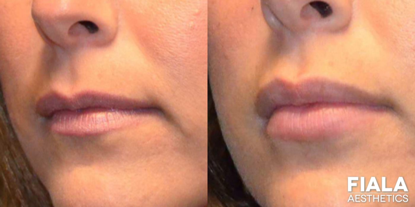 Before and after Dermal Fillers case 13938 - Angle 3