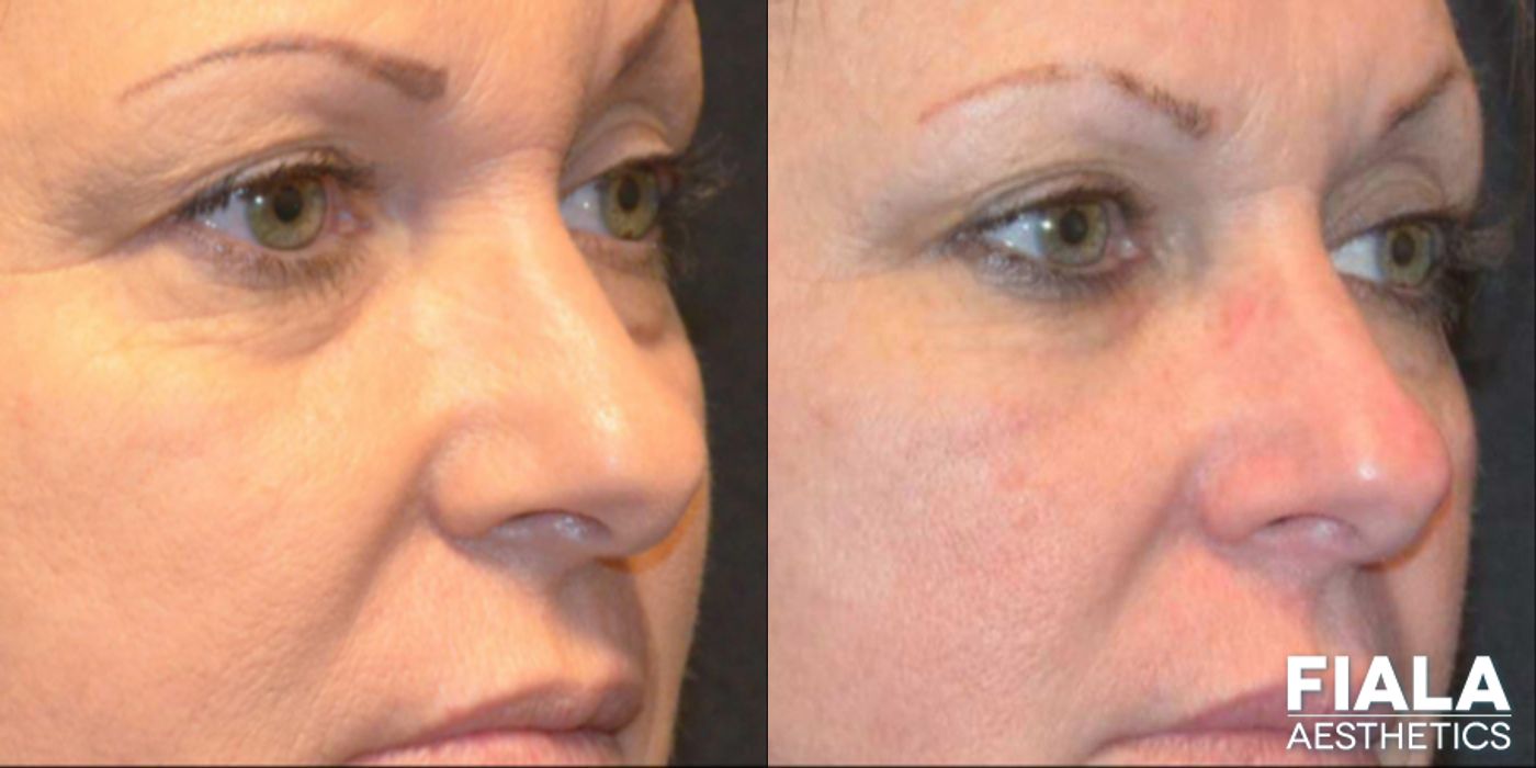 Before and after Dermal Fillers case 13936 - Angle 3