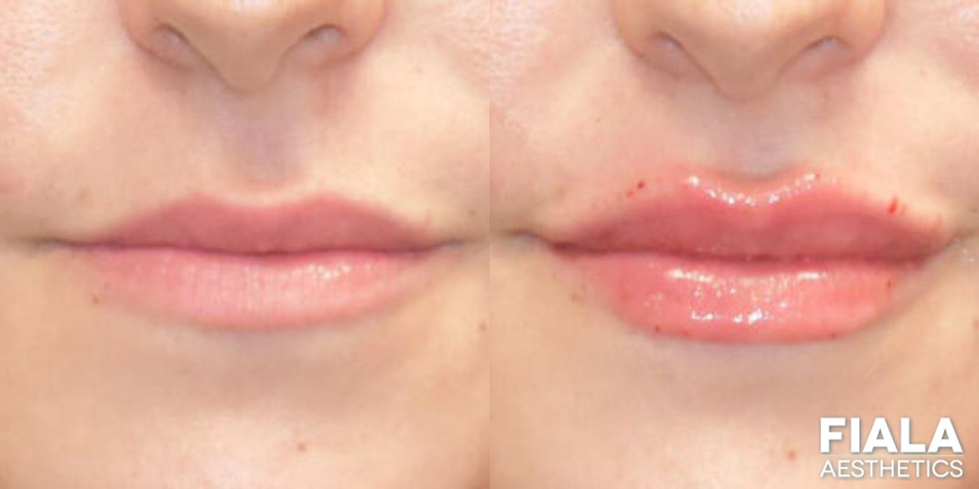 Before and after Dermal Fillers case 13921