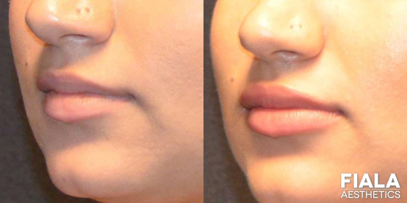 Before and after Dermal Fillers case 13941 - Angle 3