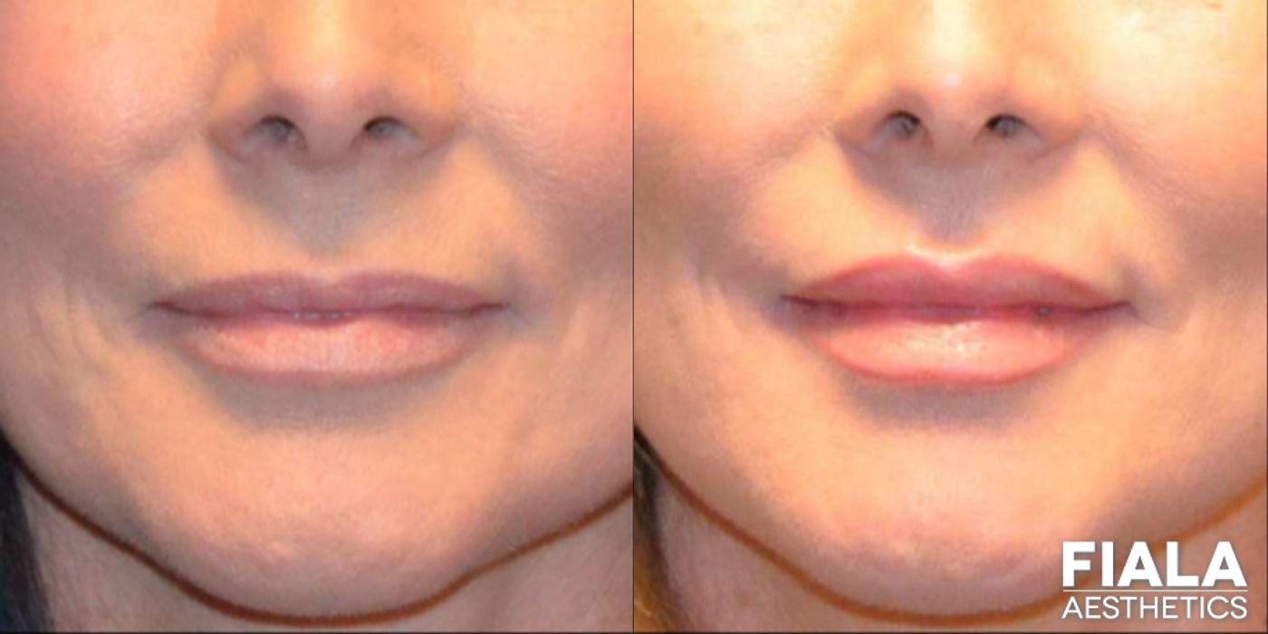 Before and after Dermal Fillers case 13940