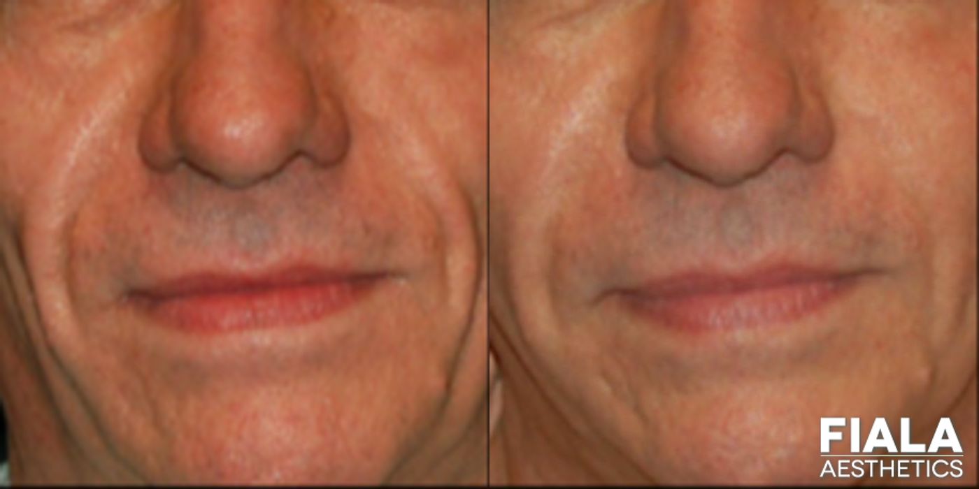 Before and after Dermal Fillers case 13927