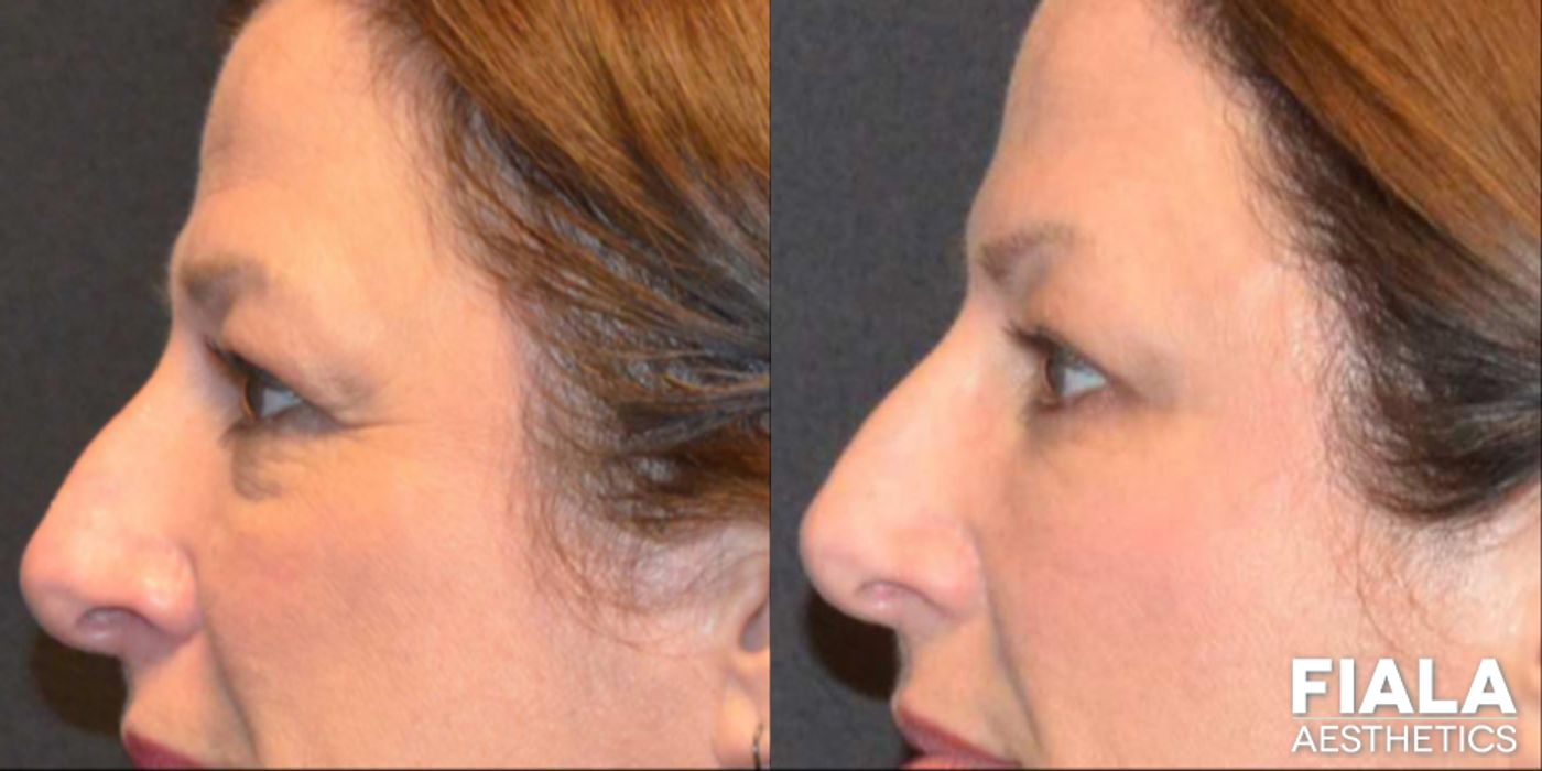 Before and after Dermal Fillers case 13933 - Angle 5