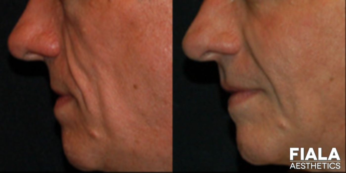 Before and after Dermal Fillers case 13929 - Angle 2