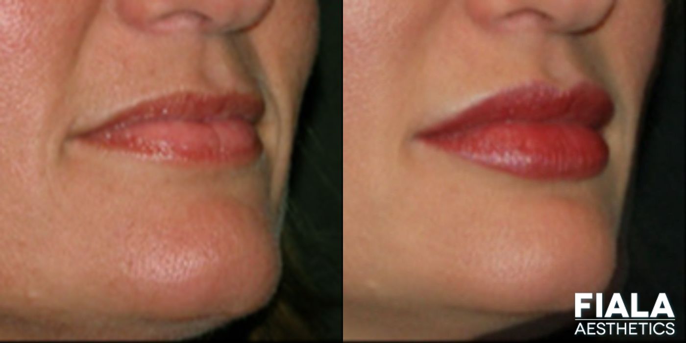 Before and after Dermal Fillers case 13924 - Angle 2