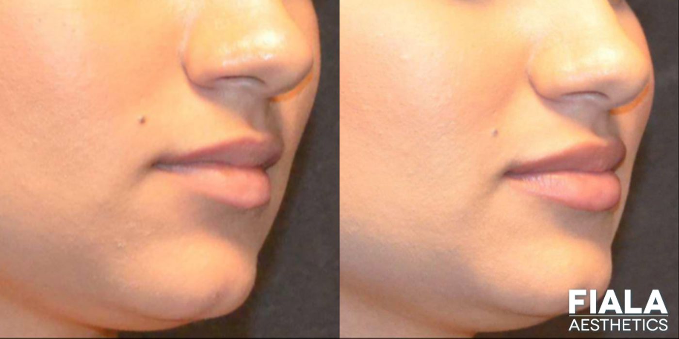 Before and after Dermal Fillers case 13941 - Angle 2