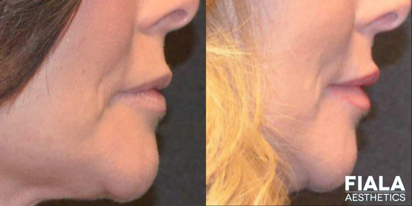 Before and after Dermal Fillers case 13940 - Angle 3