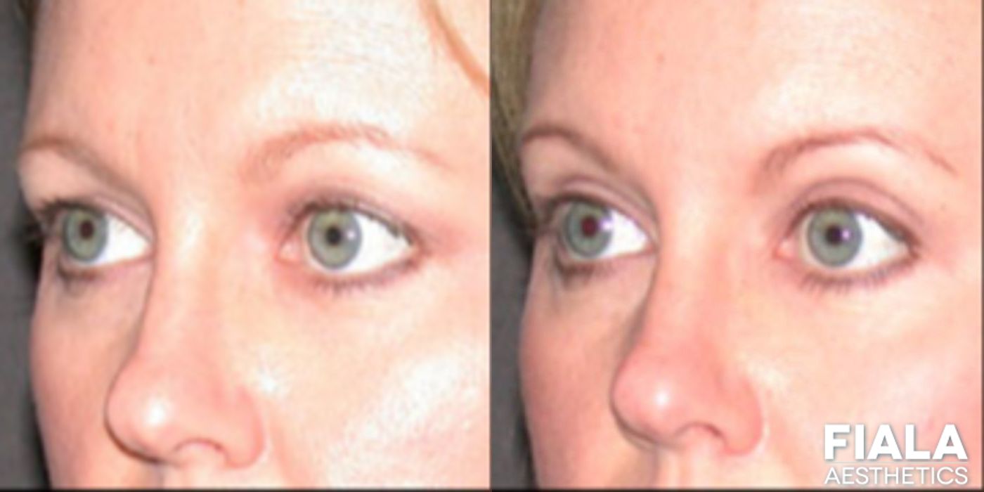 Eyelid Lift - Case 9256