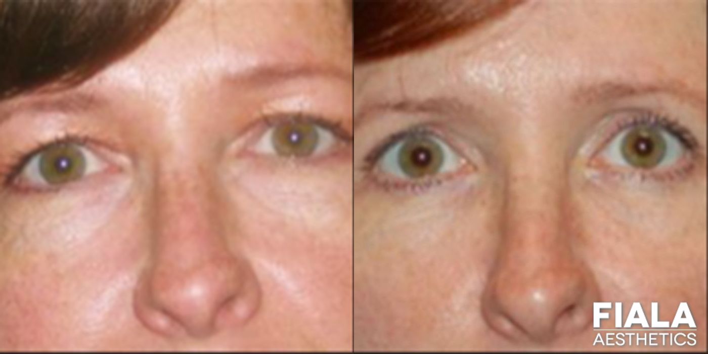 Before and after Eyelid Lift case 13866