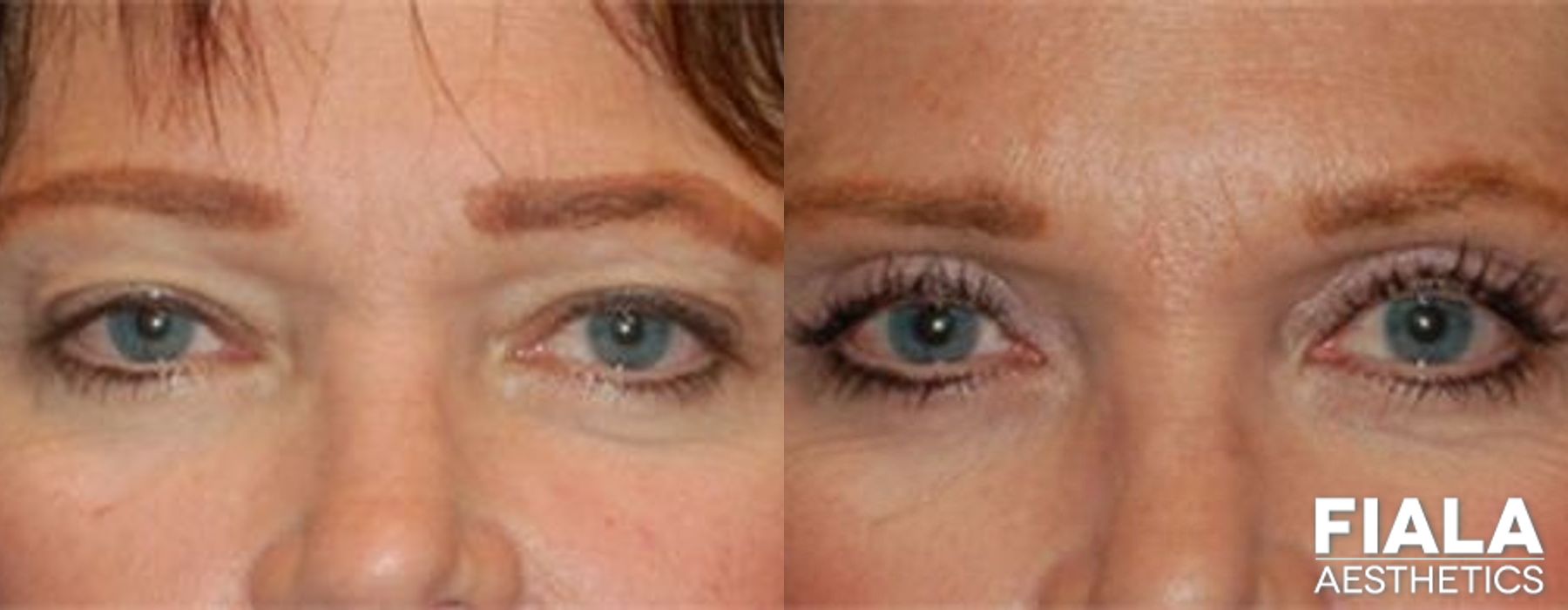 Before and after Eyelid Lift case 13870