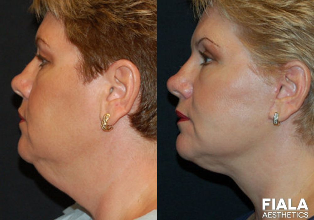 Non-surgical Facial Rejuvenation - Thumbnail 2
