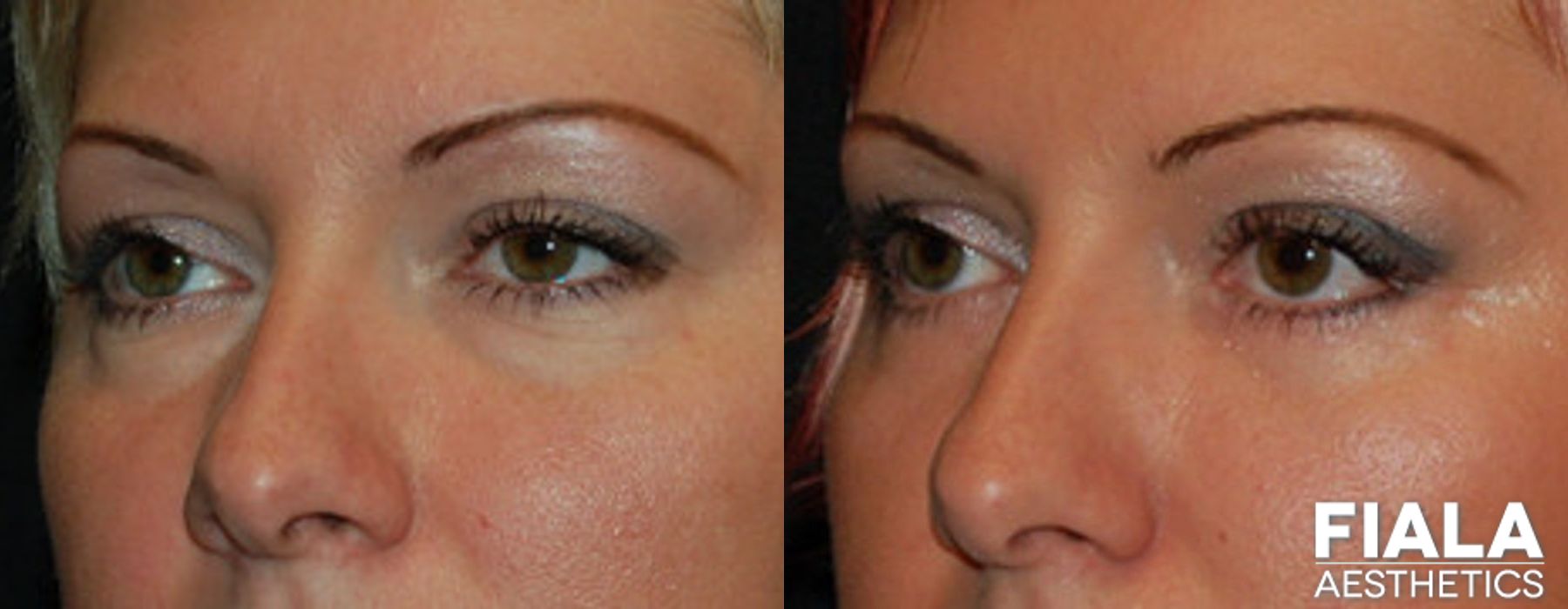 Eyelid Lift - Thumbnail 2