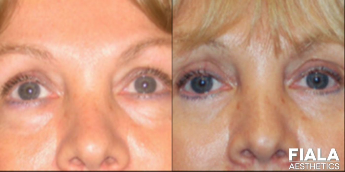 Eyelid Lift - Case 9225