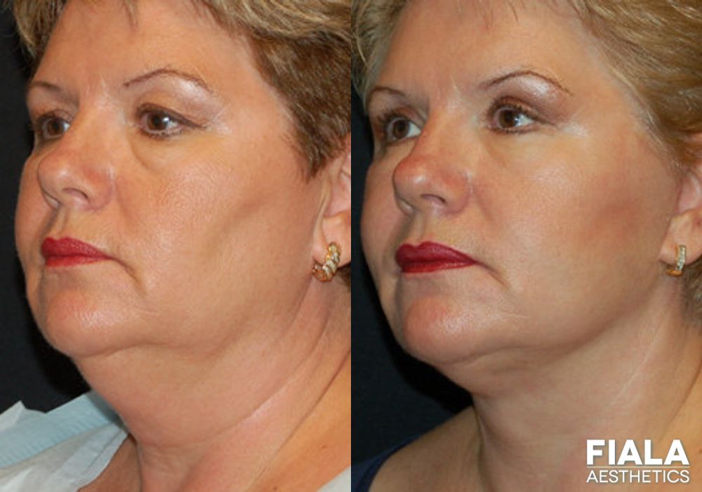 Before and after Facelift case 13898
