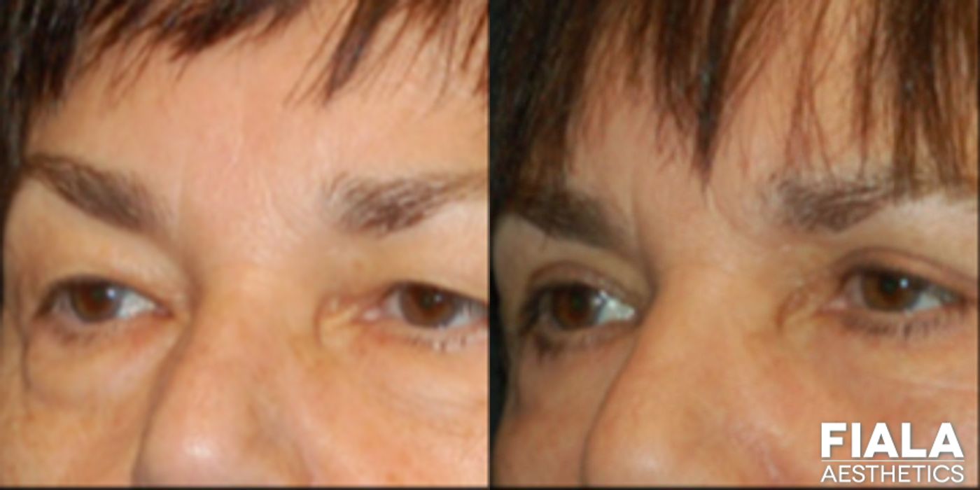 Eyelid Lift - Thumbnail 2
