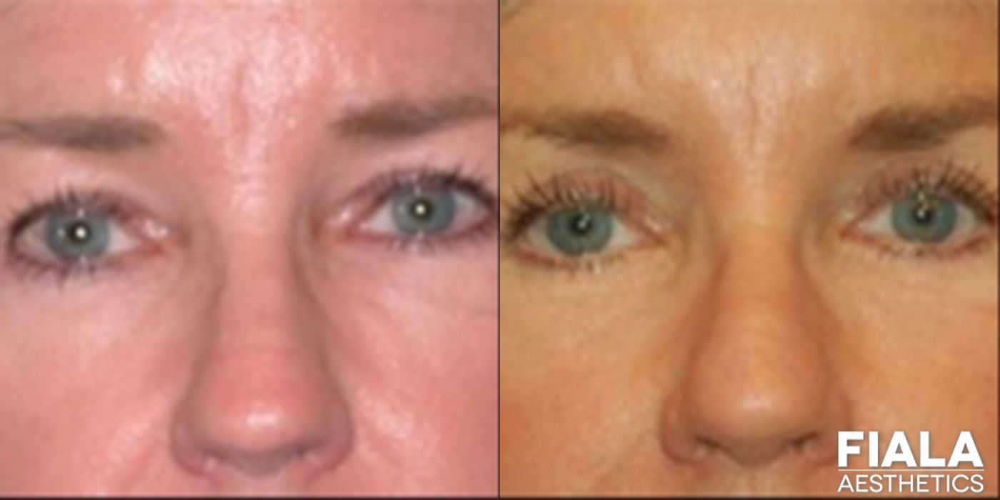 Eyelid Lift - Case 9230