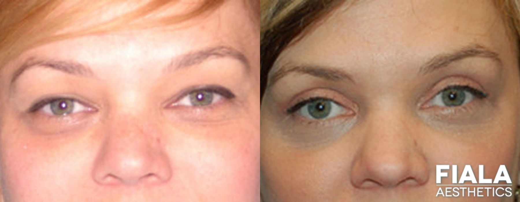 Before and after Eyelid Lift case 13874