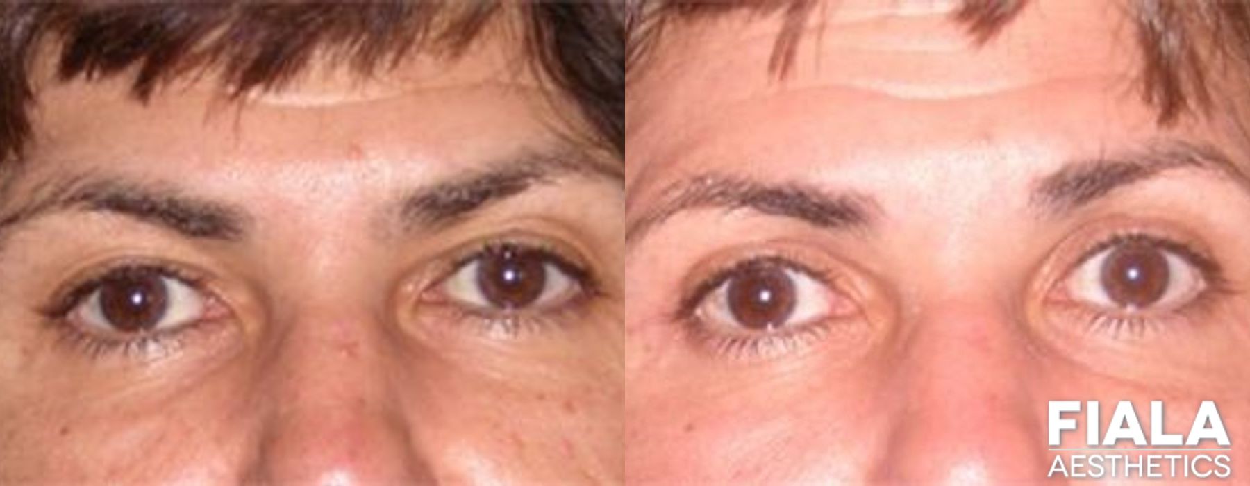 Eyelid Lift - Case 9233