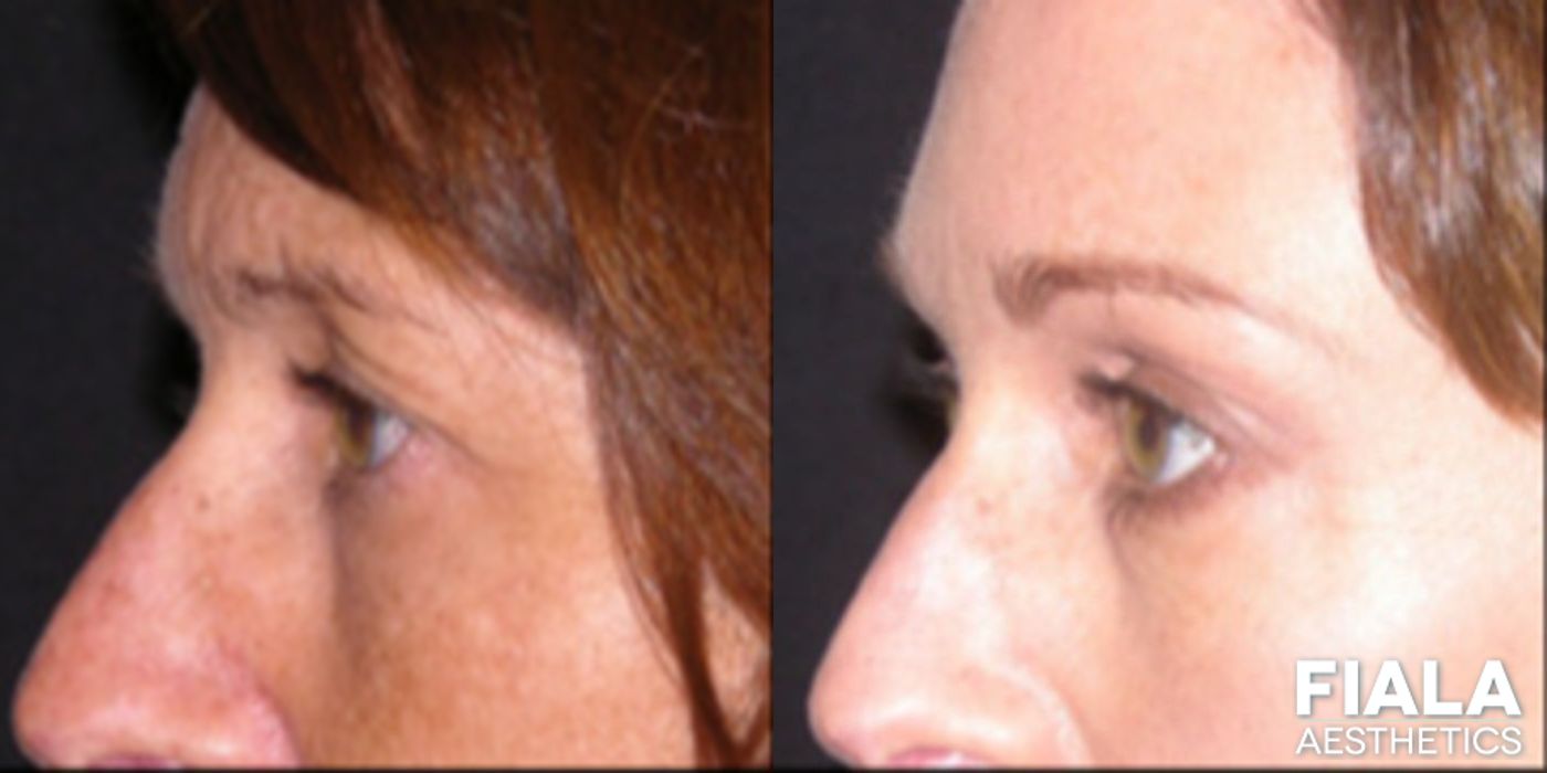 Before and after BOTOX Cosmetic case 13882 - Angle 2