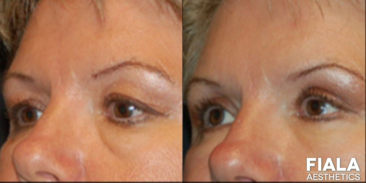 Eyelid Lift - Thumbnail 2