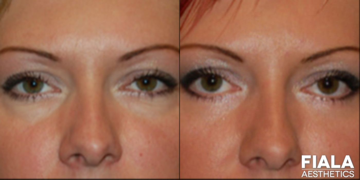 Eyelid Lift - Case 9257