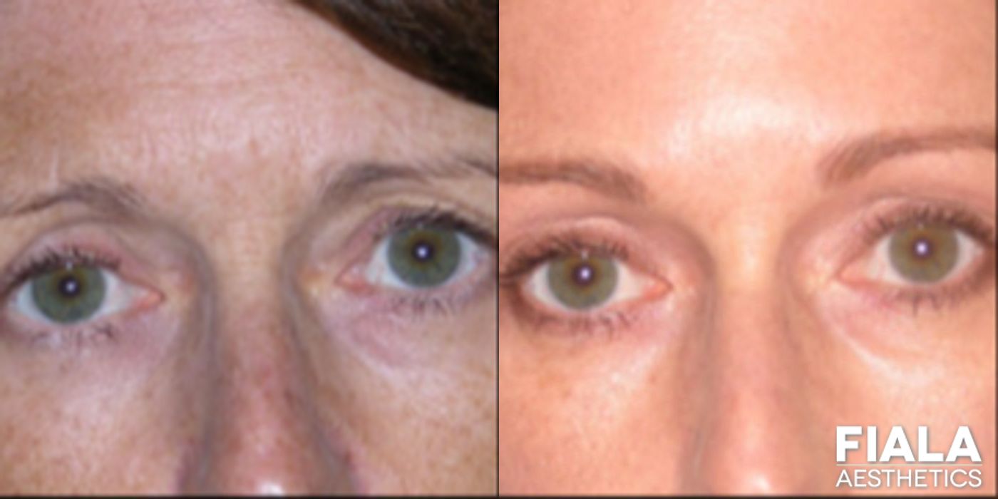Before and after BOTOX Cosmetic case 13882
