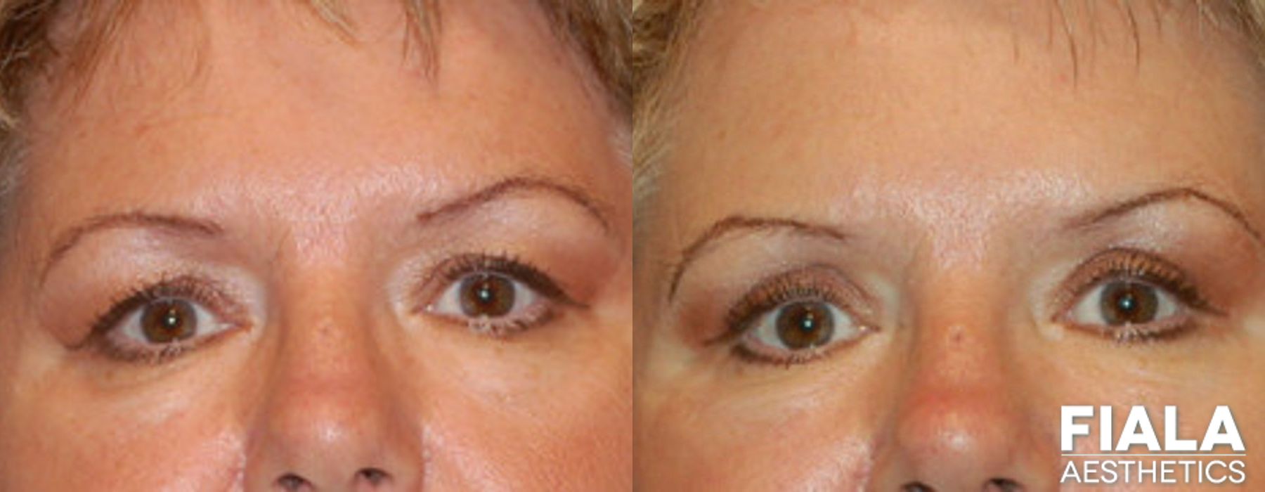 Eyelid Lift - Case 9008